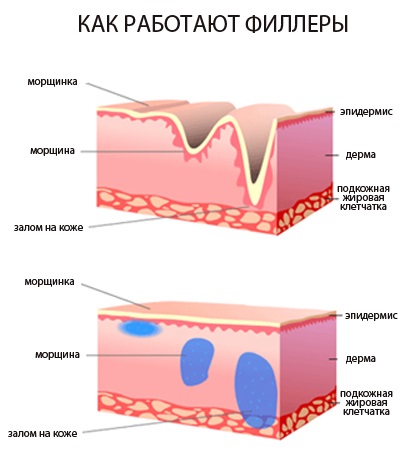 Augmentation des lèvres avec de l'acide hyaluronique, des charges, du botox, du silicone, des plastiques de contour. Photo, prix, avis