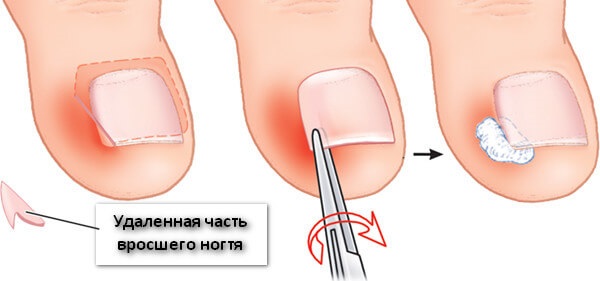 Ongle incarné. Causes d'apparition, symptômes, traitement sans chirurgie avec des remèdes populaires, pommades, chirurgie