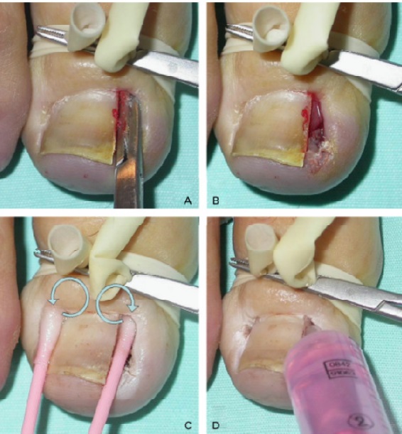 Ongle incarné. Causes d'apparition, symptômes, traitement sans chirurgie avec des remèdes populaires, pommades, chirurgie