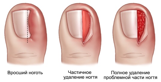 Ongle incarné. Causes d'apparition, symptômes, traitement sans chirurgie avec des remèdes populaires, pommades, chirurgie