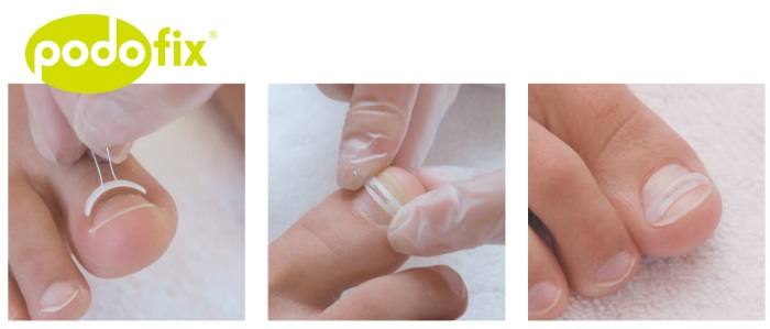 Ongle incarné. Causes d'apparition, symptômes, traitement sans chirurgie avec des remèdes populaires, pommades, chirurgie