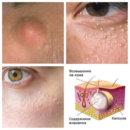 Comment se débarrasser du wen sur les paupières avec des remèdes populaires, des onguents. Causes du xanthélasme blanc et jaune