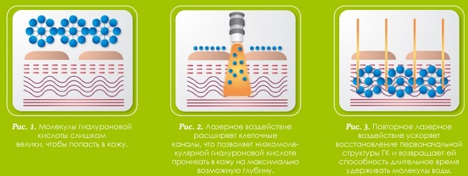 Biorévitalisation du visage.Quoi de mieux, quelle est la différence, prix: Aquashine, Ial System, Yalupro, Filorga, Princess Rich