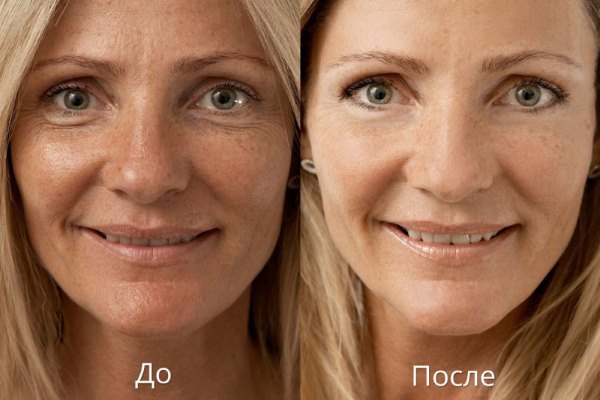 Crème Lora à l'acide hyaluronique, peptides pour le visage. Efficacité, avis des cosmétologues