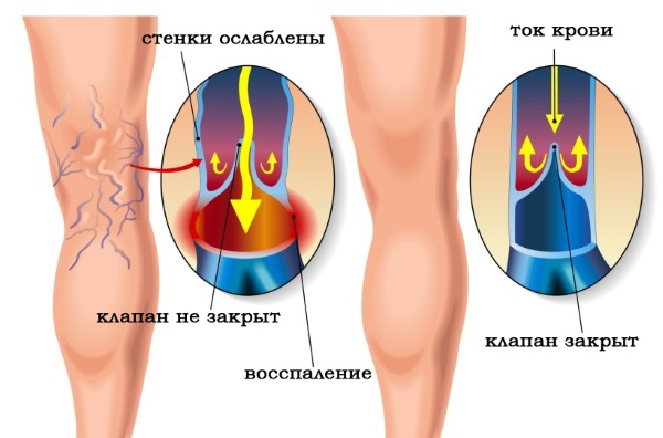 Thérapie d'endosphère - qu'est-ce que c'est, revues de massage, résultats, prix. Appareils de correction de la cellulite