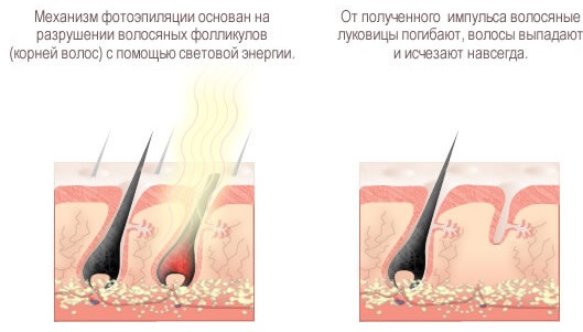 Épilation et épilation - quelle est la différence: sucre, cire, crèmes, bandes pour la zone intime, épilation au laser en salon et à la maison