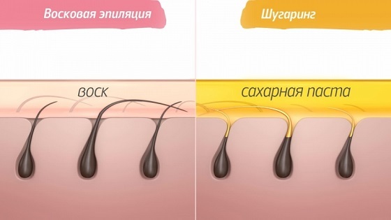 Épilation et épilation - quelle est la différence: sucre, cire, crèmes, bandes pour la zone intime, épilation au laser en salon et à la maison