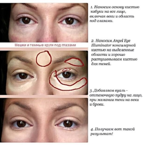 Comment se débarrasser rapidement des ecchymoses sous les yeux à la maison