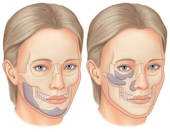 Comment enlever les volées sur le visage, restaurer l'ovale: exercices, procédures en cosmétologie, gymnastique, serrage