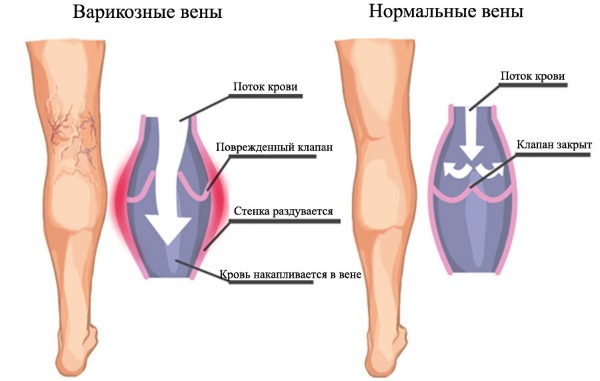 Crème de Zorka. Mode d'emploi pour les personnes aux talons fissurés, aux varices, au psoriasis, aux éperons de talon, à la dermatite, à l'eczéma, aux hémorroïdes