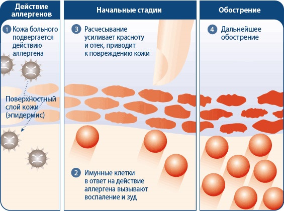 Crème de Zorka. Mode d'emploi pour les personnes aux talons fissurés, aux varices, au psoriasis, aux éperons de talon, à la dermatite, à l'eczéma, aux hémorroïdes