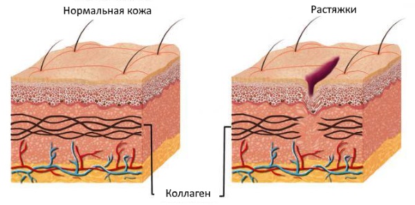 Crème de Zorka. Mode d'emploi pour les personnes aux talons fissurés, aux varices, au psoriasis, aux éperons de talon, à la dermatite, à l'eczéma, aux hémorroïdes