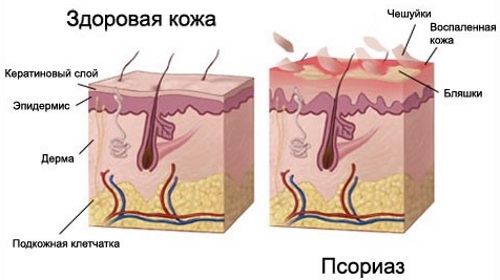 Crème de Zorka. Mode d'emploi pour les personnes souffrant de talons fissurés, de varices, de psoriasis, d'épine de talon, de dermatite, d'eczéma, d'hémorroïdes