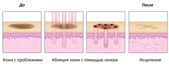 Nanoperforation laser du visage, vergetures, cicatrices, post-acné. Avis des médecins, contre-indications, conséquences