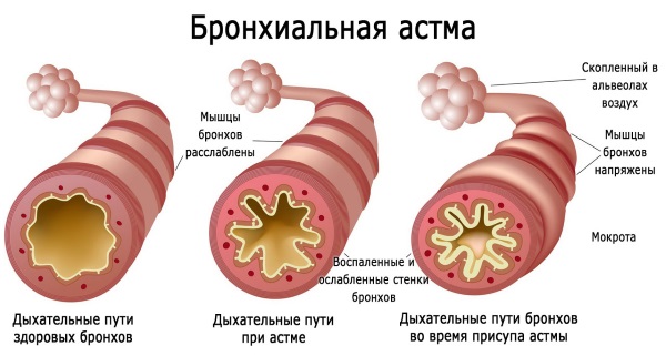 Huile de chélidoine. Propriétés et application pour les maladies cutanées et fongiques, en cosmétologie, gynécologie