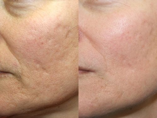 Microneedling: ce que c'est, comment c'est fait. Appareils, contre-indications, prix de la procédure, avis