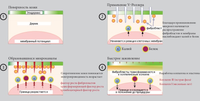 Microneedling: ce que c'est, comment c'est fait. Appareils, contre-indications, prix de la procédure, avis