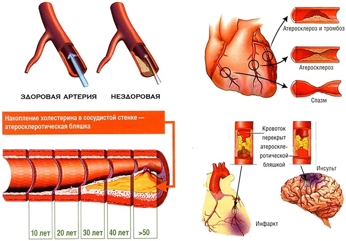 Muscles du dos: exercices pour renforcer à la maison, en salle de sport, avec ostéochondrose, scoliose