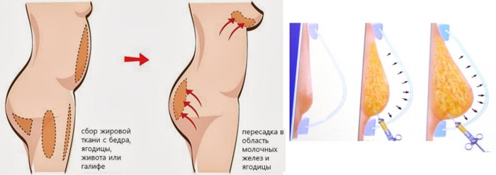 Opération de mammoplastie: réduction, augmentation, endoscopie laser, sans implants, masculinisation. Stades, rééducation et complications