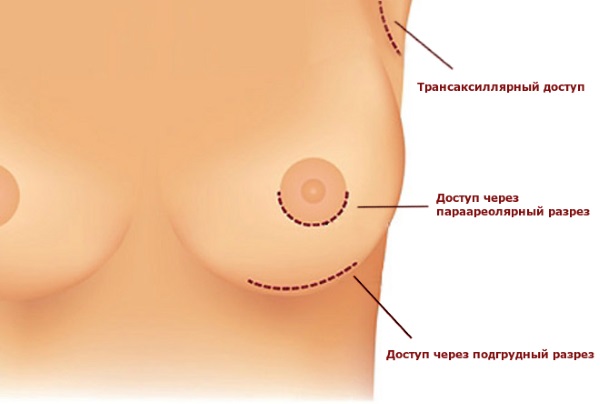 Opération de mammoplastie: réduction, augmentation, endoscopie laser, sans implants, masculinisation. Stades, rééducation et complications