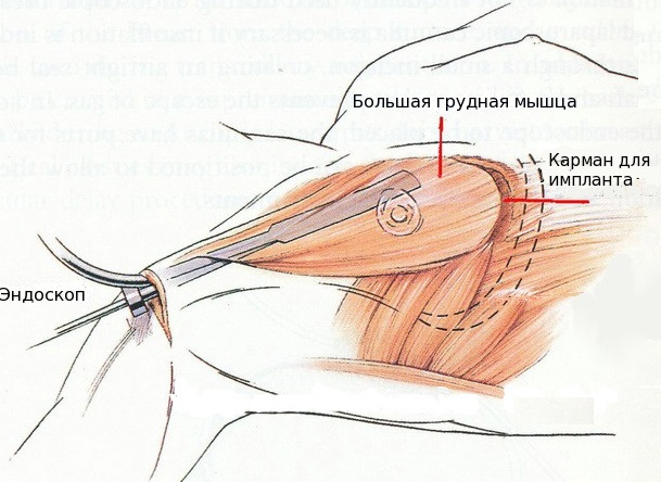 Opération de mammoplastie: réduction, augmentation, endoscopie laser, sans implants, masculinisation. Stades, rééducation et complications