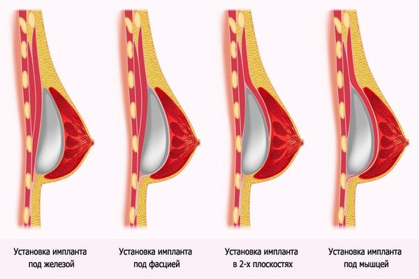 Opération de mammoplastie: réduction, augmentation, endoscopie laser, sans implants, masculinisation. Stades, rééducation et complications