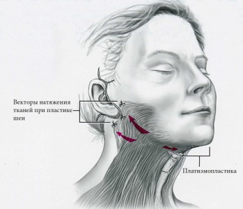 Platysmoplastie - qu'est-ce que c'est, types: médial, Hollywood, corset, médian, endoscopique. Avis et prix sur la procédure