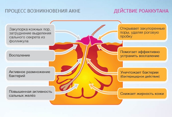 Roaccutane. Mode d'emploi, effets secondaires. Comment utiliser les pilules pour l'acné, les analogues, le prix
