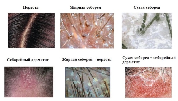 Pâte de Sulcena. Mode d'emploi pour la croissance des cheveux, contre les pellicules, la chute des cheveux, le gras