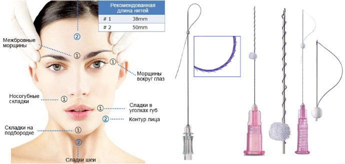 Threadlifting avec mésothreads 3D pour le visage, les lèvres, le front, l'abdomen. Photos avant et après, avis, prix de la procédure