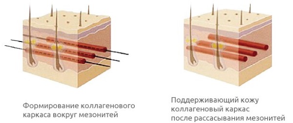 Threadlifting avec mésothreads 3D pour le visage, les lèvres, le front, l'abdomen. Photos avant et après, avis, prix de la procédure