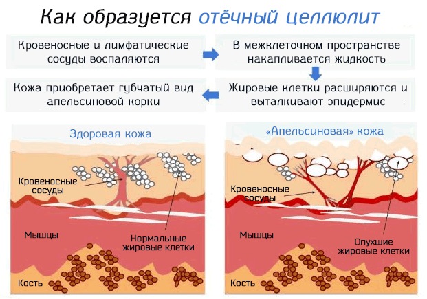 Cellulite sur les jambes et le bas. Comment se débarrasser: exercice, régime, enveloppements, massage, masques, gommages