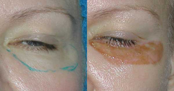 Blépharoplastie non chirurgicale des paupières supérieures et inférieures: circulaire, laser, matériel. Prix, rééducation et complications possibles