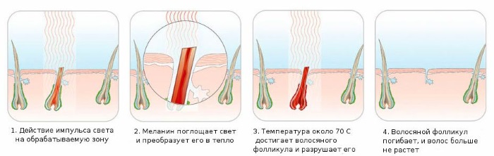 Épilation AFT - épilation au laser sur le visage et le corps, zone bikini au salon et à la maison. Appareils, avis et prix