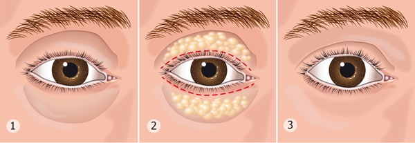 Blépharoplastie non chirurgicale des paupières supérieures et inférieures: circulaire, laser, matériel. Prix, rééducation et complications possibles