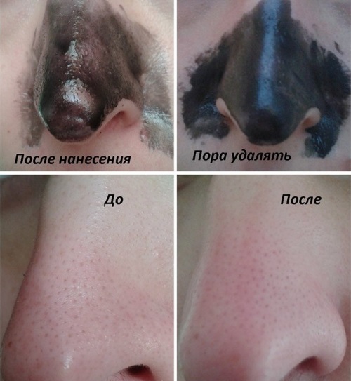 Argile noire pour le visage, les cheveux, la peau du corps. Propriétés et application: masques contre l'acné, les points noirs, la cellulite, le nettoyage, les enveloppements minceur