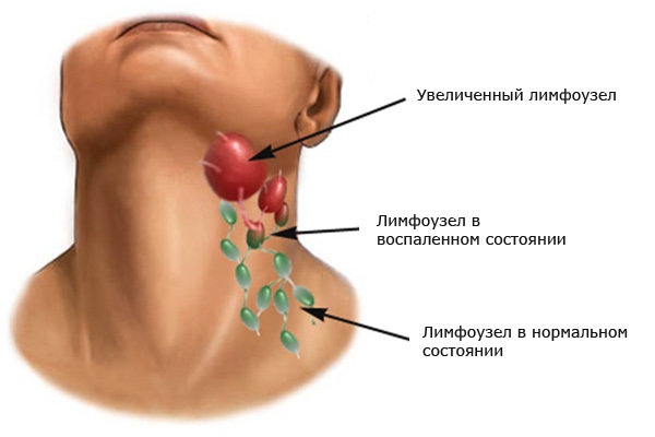 Formation EMS (EMS) - qu'est-ce que c'est, les avantages et les inconvénients, les résultats, les photos, les avis des médecins sur la myostimulation