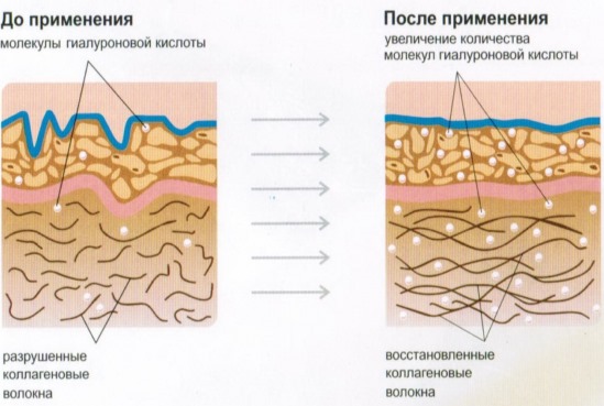 Remplisseurs dans les plis nasogéniens, sous les yeux, dans les lèvres, dans les pommettes. Correction du nez, sillon nasolacrimal. Contour du visage