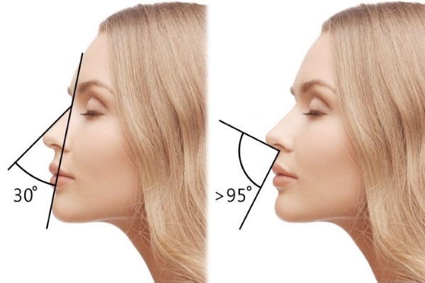 Remplisseurs dans les plis nasogéniens, sous les yeux, dans les lèvres, dans les pommettes. Correction du nez, sillon nasolacrimal. Contour du visage