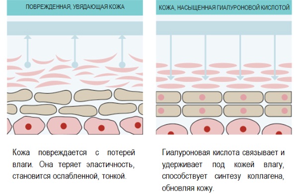 Phonophorèse faciale avec hydrocortisone, caripaïne, acide hyaluronique. Indications et contre-indications, appareils pour les procédures échographiques