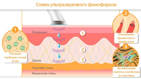 Phonophorèse faciale avec hydrocortisone, caripaïne, acide hyaluronique. Indications et contre-indications, appareils pour les procédures échographiques