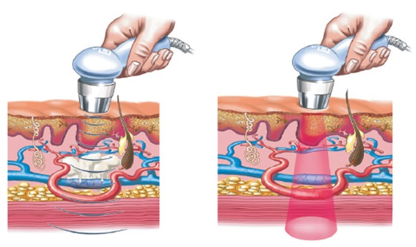 Phonophorèse faciale avec hydrocortisone, caripaïne, acide hyaluronique. Indications et contre-indications, appareils pour les procédures échographiques