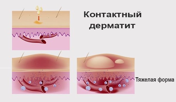 Qu'est-ce que l'hydroquinone, application en cosmétologie: crèmes blanchissantes, peeling, pommade, comprimés. Achroactive Max, avis