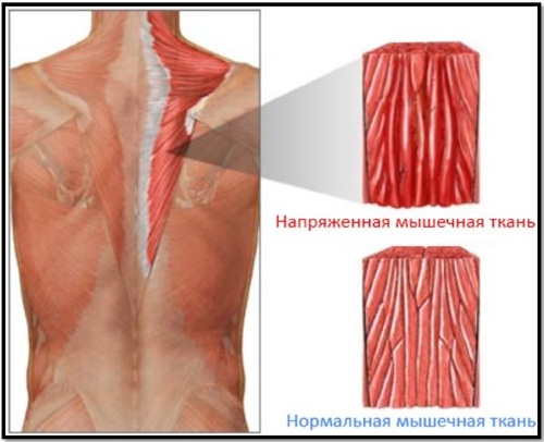 Comment se débarrasser des douleurs musculaires après l'entraînement: onguents, pilules, gels analgésiques, remèdes populaires