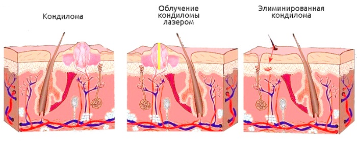 Comment se débarrasser des papillomes sur le corps avec du folk, des médicaments, des méthodes chirurgicales