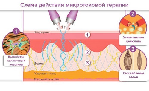 Comment éliminer les rides sur le front, sous les yeux, nasogéniens, au-dessus de la lèvre supérieure, entre les sourcils, sur le cou, entre les sourcils, imiter