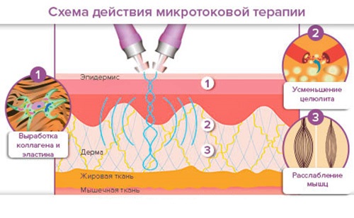 Lifting du visage: qu'est-ce que c'est, SMAS, RF, plasma, massage, ultrasons, filament, endoscopique, ondes radio, vecteur, radiofréquence, laser, acupuncture