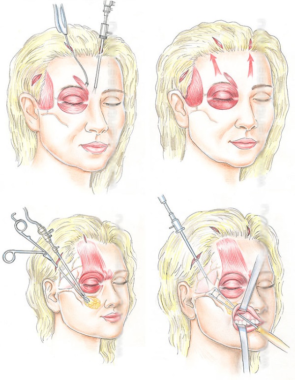 Lifting du visage: qu'est-ce que c'est, SMAS, RF, plasma, massage, ultrasons, filament, endoscopique, ondes radio, vecteur, radiofréquence, laser, acupuncture