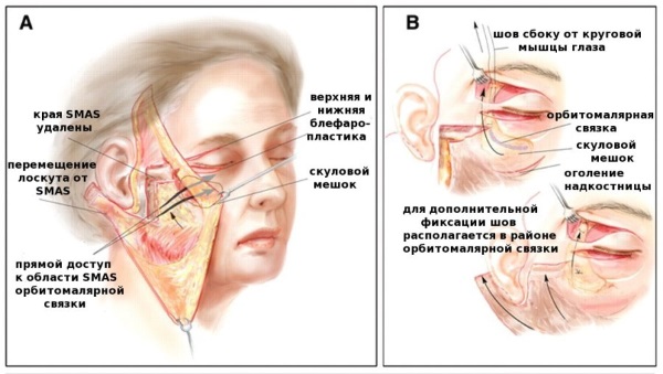 Lifting du visage: qu'est-ce que c'est, SMAS, RF, plasma, massage, ultrasons, filament, endoscopique, ondes radio, vecteur, radiofréquence, laser, acupuncture