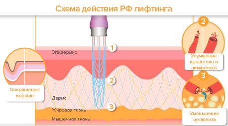 Lifting du visage: qu'est-ce que c'est, SMAS, RF, plasma, massage, ultrasons, filament, endoscopique, ondes radio, vecteur, radiofréquence, laser, acupuncture